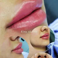 جشنواره ویژه کاشت ابرو ،بوتاکس، فیلر ..