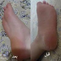 رفع ترک پاهات با من