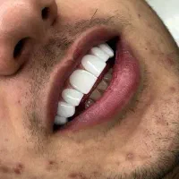 ۱۶ واحد کامپوزیت فقط ۱۶ تومن 7 سال گارانتی