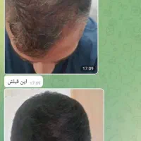 پک رفع ریزش مو و رویش مجدد موی اعجاز دلبرانه
