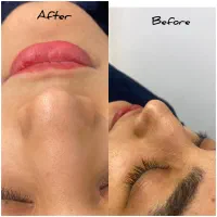فیشال و پاکسازی تخصصی پوست بندرلنگه