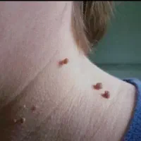 زگیل تناسلی درمان کن/محرمانه/سریع/بی بازگشت