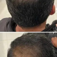 مزو و پی ارپی صورت و مو ( تضمینی قطع کامل ریزش مو)
