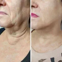 کرم لیفتینگ صورت و گردن