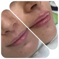 بوتاکس ،ژل،خدمات زیبایی توسط پزشک زیبایی در اهواز