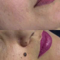 با یک جلسه از شر خال لک خال گوشتی زگیل خلاص میشی