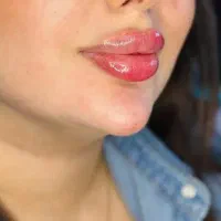 ۷۰٪ تخفیف برای فیلر ژل بوتاکس برای مراجعین مطب