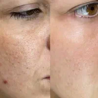 لک و جوش های صورتت اعتماد به نفست کم کرده
