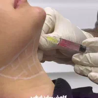 تخفیف ویژه ژل و بوتاکس توسط پزشک