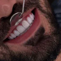 کامپوزیت دندان لمینت (دندانپزشکی)