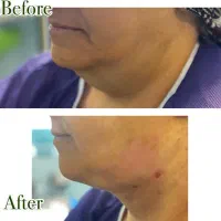 کاهش سایز دور شکم وران در یک جلسه