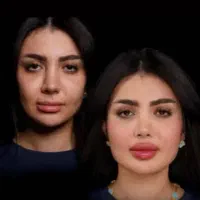 تزریق فیلر(ژل) وبوتاکس ومزو ژل
