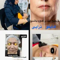 لیزر لک صورت،حذف تتو...