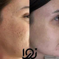 رفع افتادگی پلک بدون جراحی و رفع لک صورت و جوانساز
