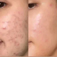معجزه درمان جوش بدون دستگاه و کمترین هزینه