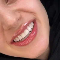 کامپوزیت،لمینت،ایمپلنت،لبخند مرواریدی