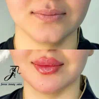 آف ویژه ژل (فیلر)بوتاکس مزو انزیم