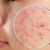 اگه پوست خوب میخوای اینو نبین