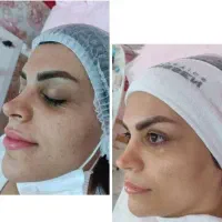 پاکسازی پوست تخفیف ویژه به مناسبت ماه محرم
