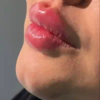 جشنواره ژل-مزو جوانسازی-بوتاکس چشم گربه ای