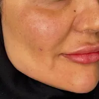 فیلر/ژل لب صورت کاشت مژه روباهی/کایلی..|خدمات آرایشگری و زیبایی|پاکدشت, |دیوار