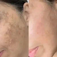 فروش و انجام  گلوتاتون سفیدکننده فوری صورت وبدن