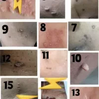 ریشه کن شدن زگیل تناسلی،میخچه، خال بامحلول گیاهی