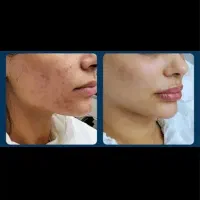 تزریق prp و مزوژل و بوتاکس با مناسب ترین قیمت