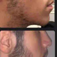 رویش ریش و سیبیل