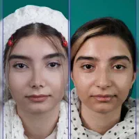 عمل بینی با ۳۹ میلیون/قیمت سال قبل