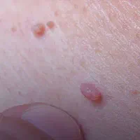 برداشتن خال گوشتی و زگیل پاک کردن تاتو