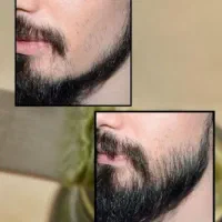 رویش ریش و مو