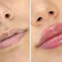 انجام فیلرلب بوتاکس زاویه سازی زیر نظر پزشک