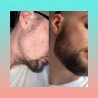 ریش اعتباره