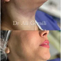 ساکشن غبغب/لیفت با نخ/ژل لب /کانتورینگ صورت