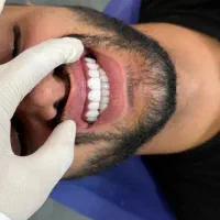 شرایط اقساطی برای کامپوزیت فکی۱۴وعصبکشی وپرکردن۳م