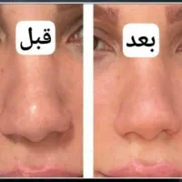 کوچک شدن بینی با سرم لیفتینگ