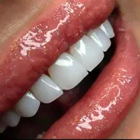 کامپوزیت دندان هرفک ۶ت نانوسرامیک/عصب کشی/ایمپلنت