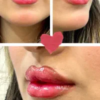 ارزان و باکیفیت ترین مرکز ‌ژل‌ و بوتاکس پارس آباد