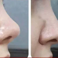 لیفت بینی در خانه بدون درد و عوارض و بیهوشی