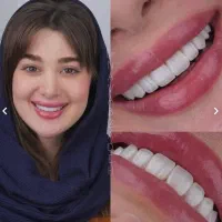 اف ویژه کامپوزیت دندان