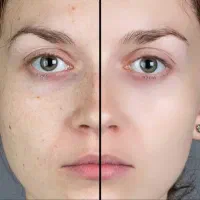 بهترین‌کرم‌سفیدکننده ضدجوش ضدلک ترمیم‌کننده دلارا