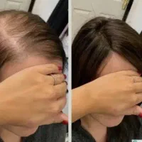 آموزش میکرونیدلینگ ،مزوتراپی سر و صورت