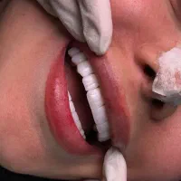 لمینت/ایمپلنت /کامپوزیت/روکش/عصبکشی