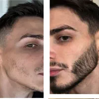 رویش ریش به صورت اصولی و ریشه ای