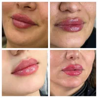 تزریق فیلر و بوتاکس توسط پزشک مجرب