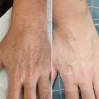 حذف 6روزه کک مک صورت و بدن