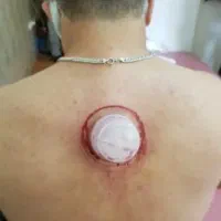 آموزش حجامت بادکش و زالودرمانی