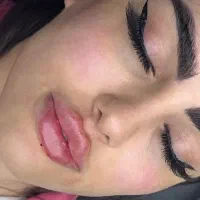 تزریق ژل ، بوتاکس و مزوژل