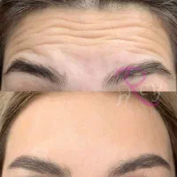 تزریق ژل و بوتاکس